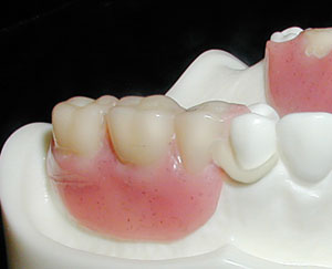 Image of dental d clasp