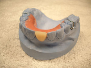 Temporary all Acrylic Partial Denture